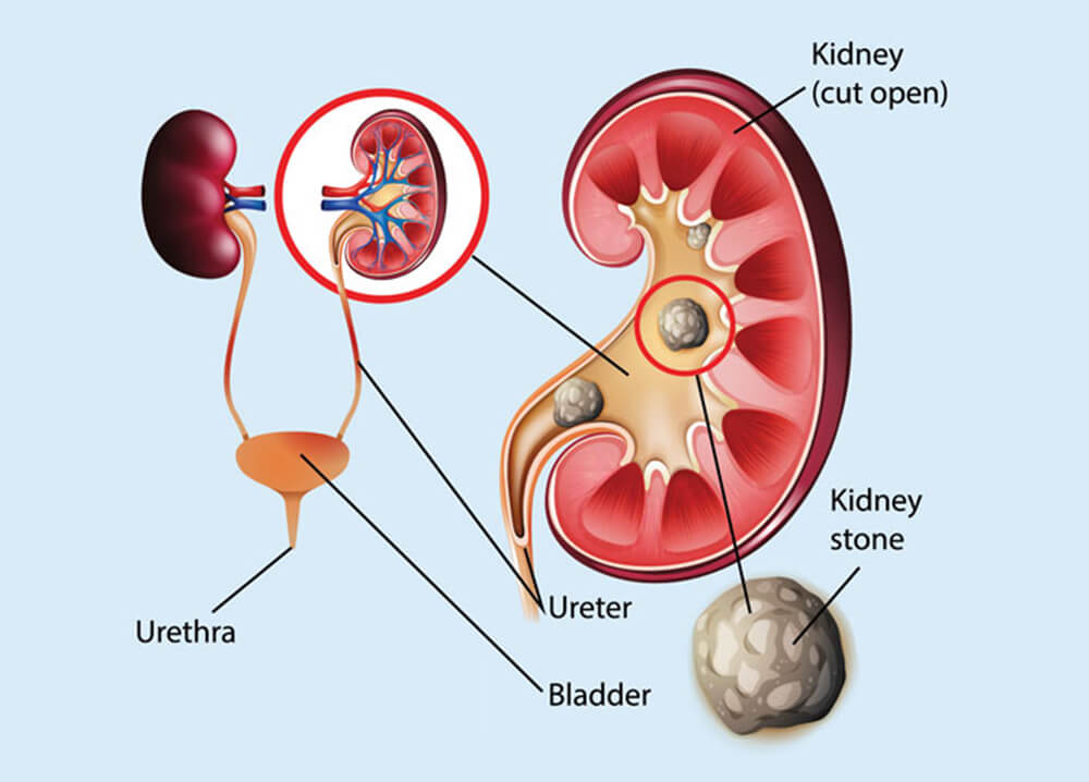 kidney stone treatment in lb nagar
